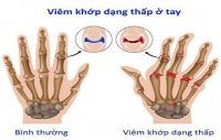benh-viem-da-khop