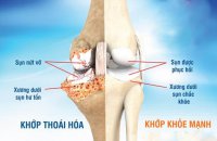 cac-trieu-chung-thoai-hoa-khop-goi-01
