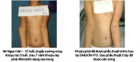 chinh_truc_khuyu_tay_truoc_va_sau_pt