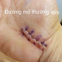 khi-nao-nen-di-kham-hoi-chung-ong-co-tay
