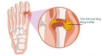 nhung-dieu-can-biet-ve-benh-gout-01