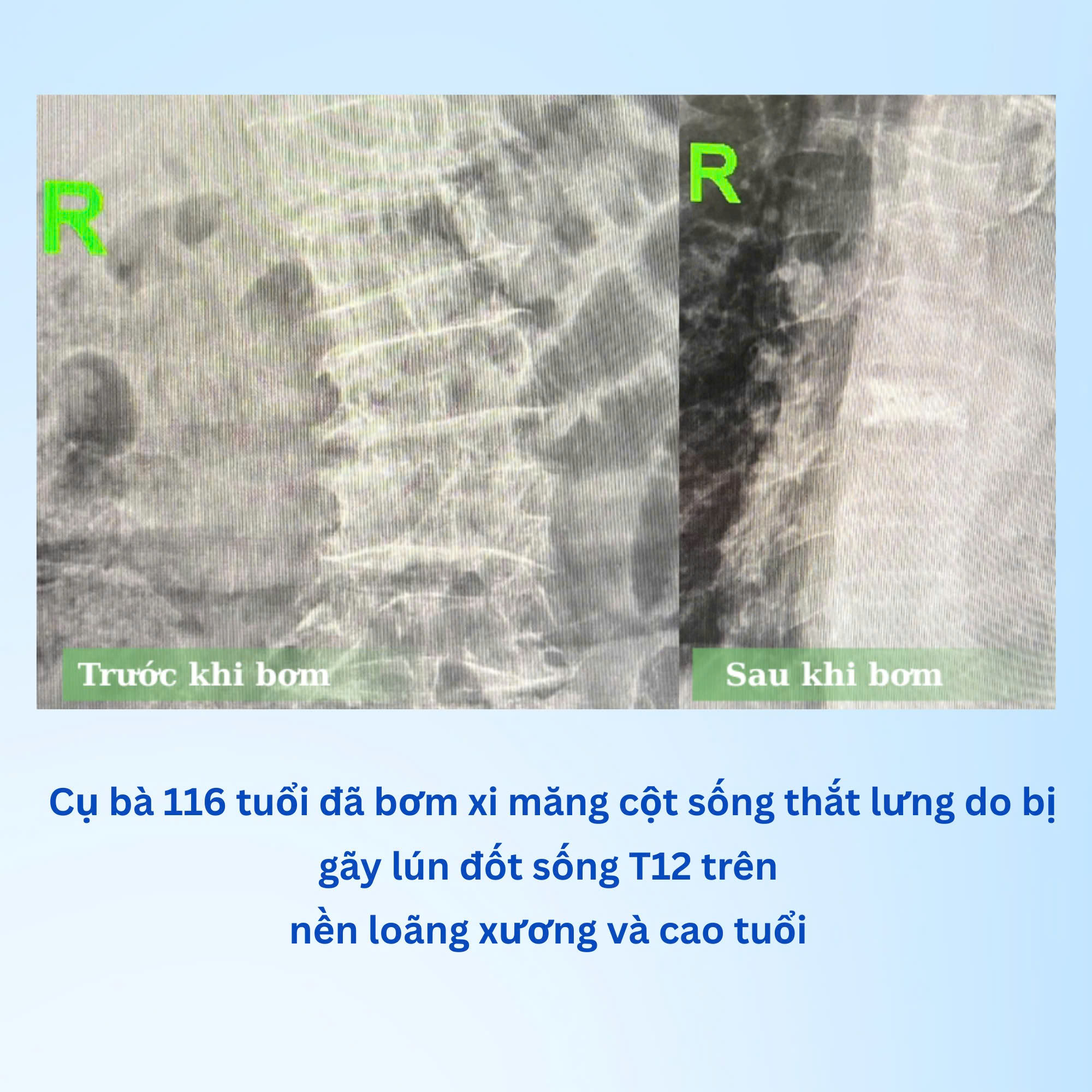 XẸP ĐỐT SỐNG DO LOÃNG XƯƠNG: PHƯƠNG PHÁP BƠM XI MĂNG SINH HỌC 2