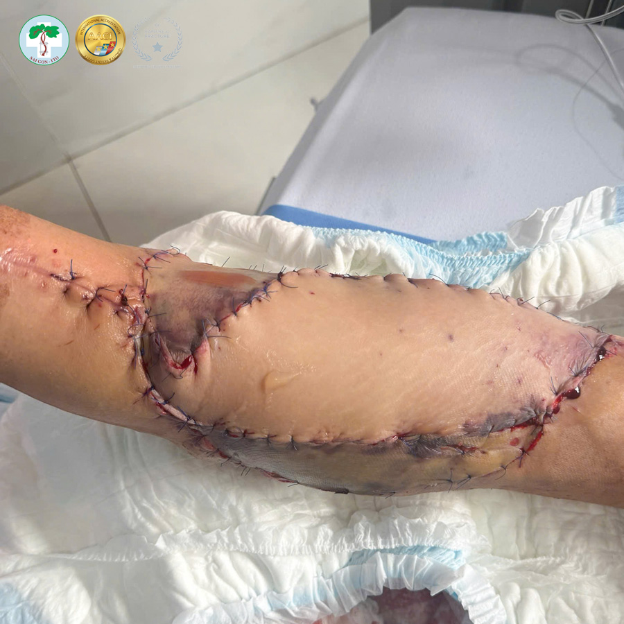 MỘT TAI NẠN LAO ĐỘNG – 2 LẦN PHẪU THUẬT ĐỂ GIỮ LẠI CHỨC NĂNG CHO CÁNH TAY 2 VET THUONG VUNG RONG CANG TAY 01